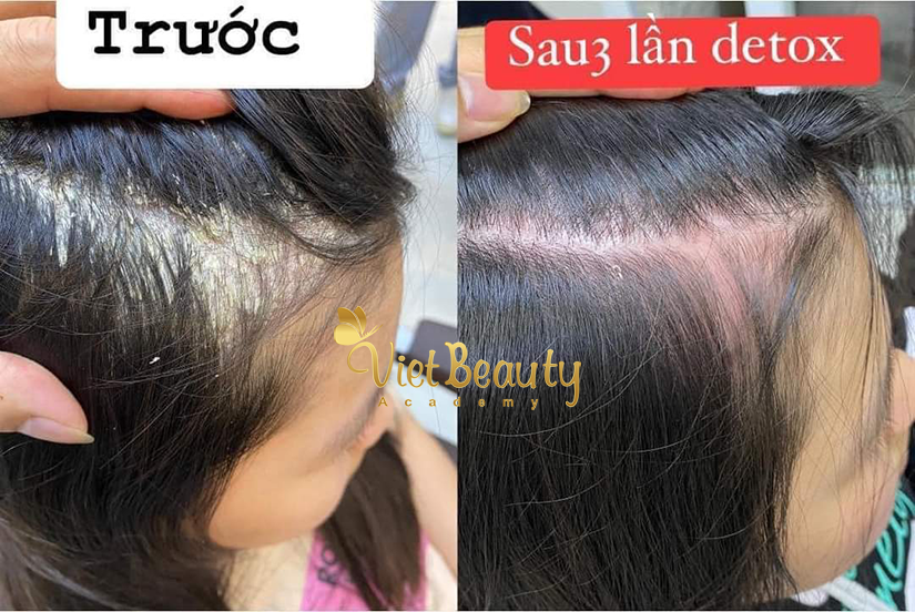 Scalp detox detox thải độc da đầu công nghệ ITALIA | VietBeauty Success Business